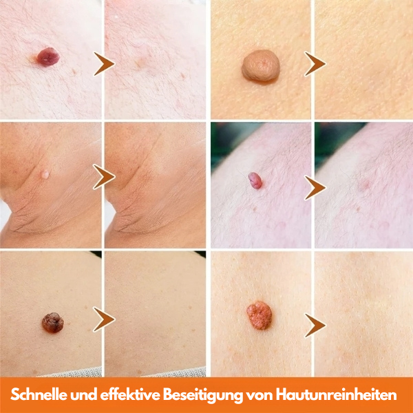 ClearSkinPro™ - Hauttag Entferner
