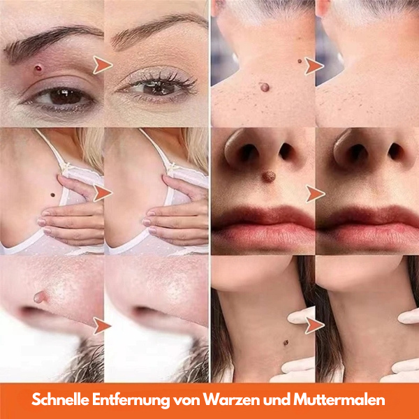 ClearSkinPro™ - Hauttag Entferner